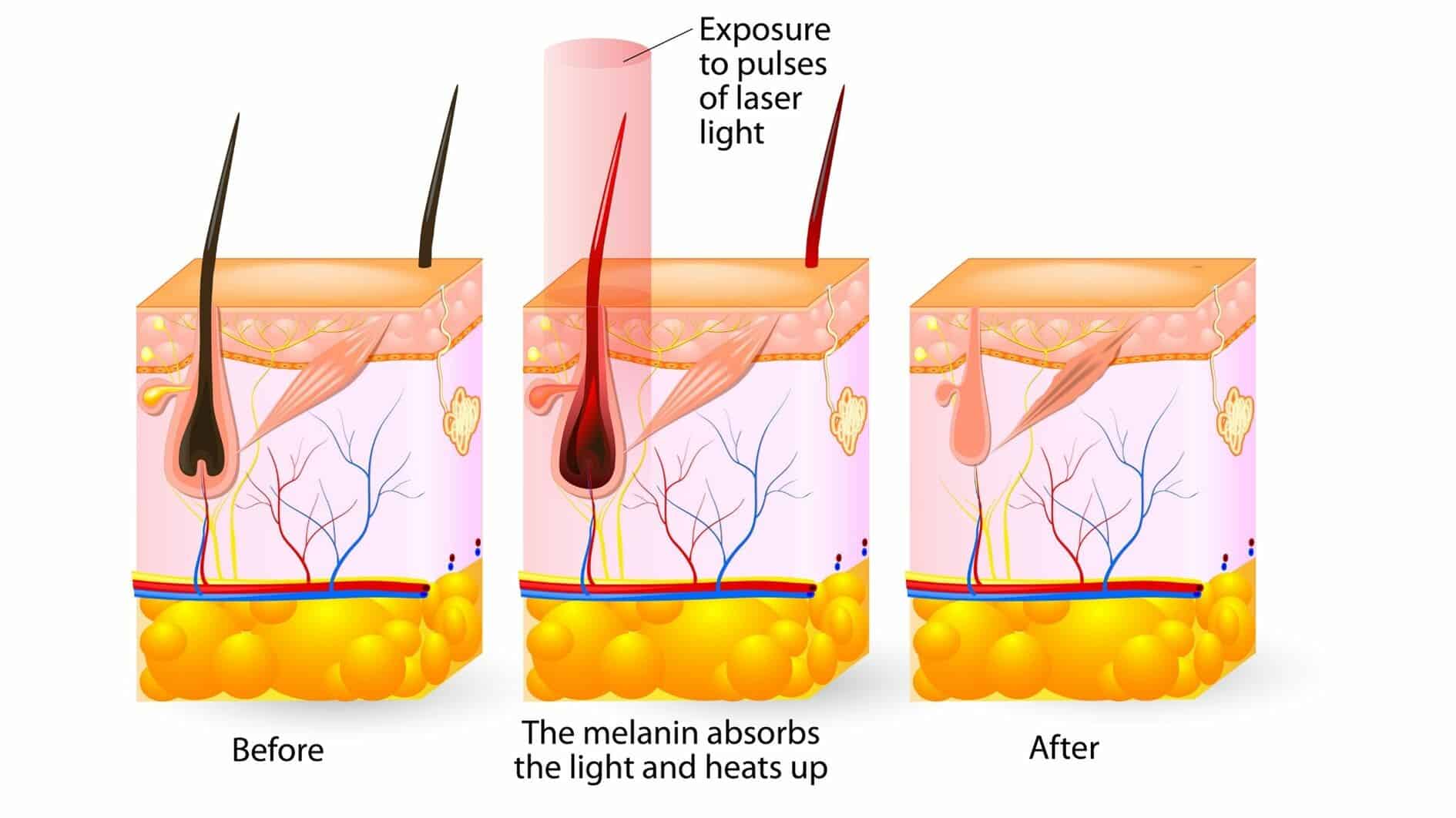 laser destroying hair follicle and 5-14 days to fall out