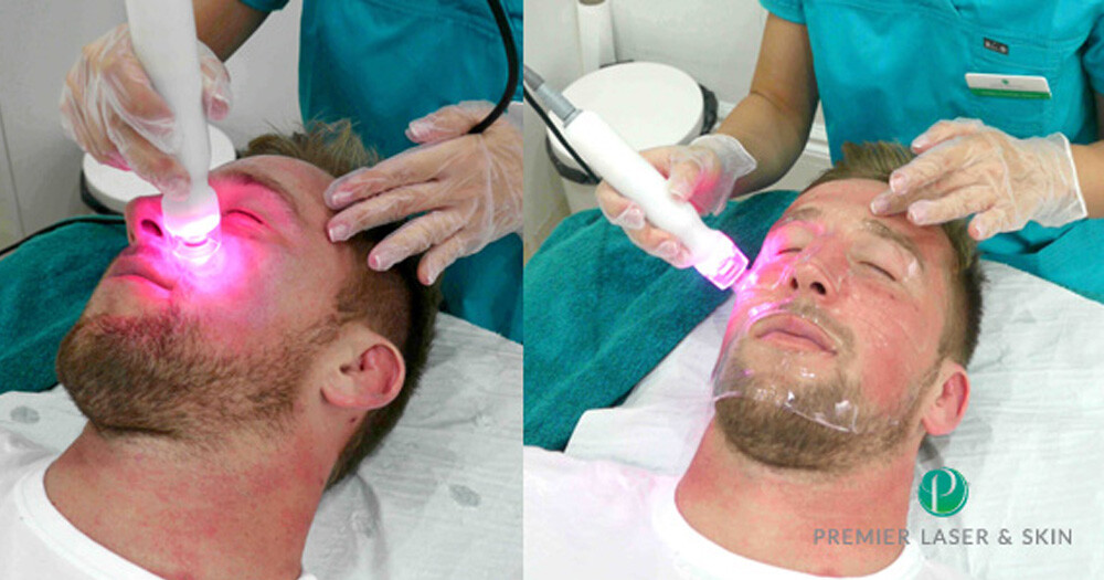Laser Hair Removal for Men's Facial Hair