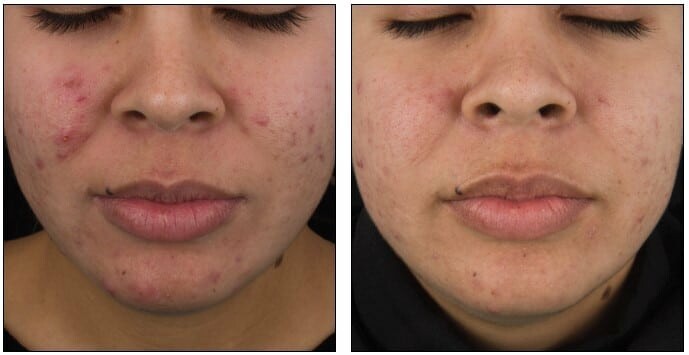DermaClear Acne Peel Before & After