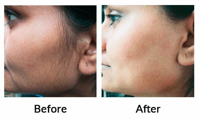 Laser hair removal before after