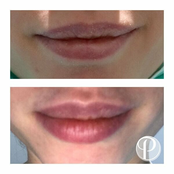 How Fillers Can Transform Your Lips