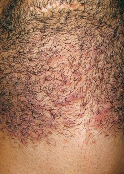 How do you get ingrown hairs? - London Premier Laser & Skin Clinic