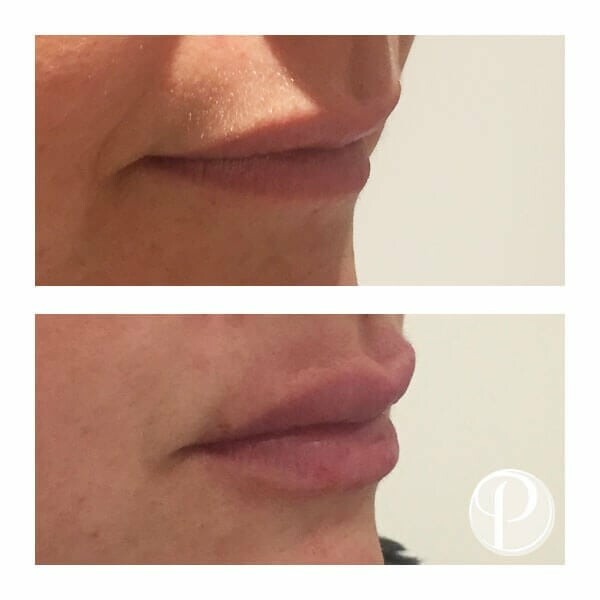 How Fillers Can Transform Your Lips