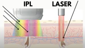 Hair Removal Using Light | Difference Between IPL & Laser