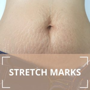 Microneedling - the solution to stretchmarks - London Premier Laser & Skin  Clinic