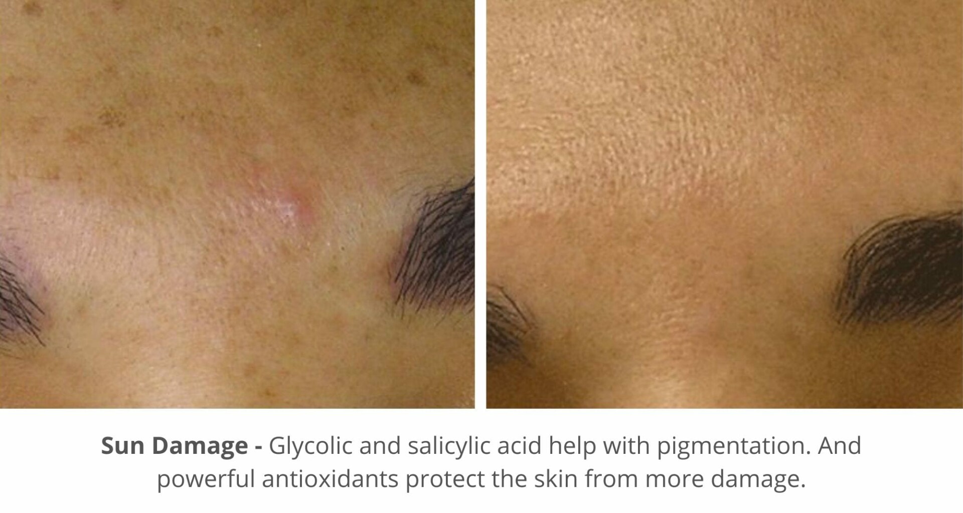 hydrafacial before and after photo for sun damage