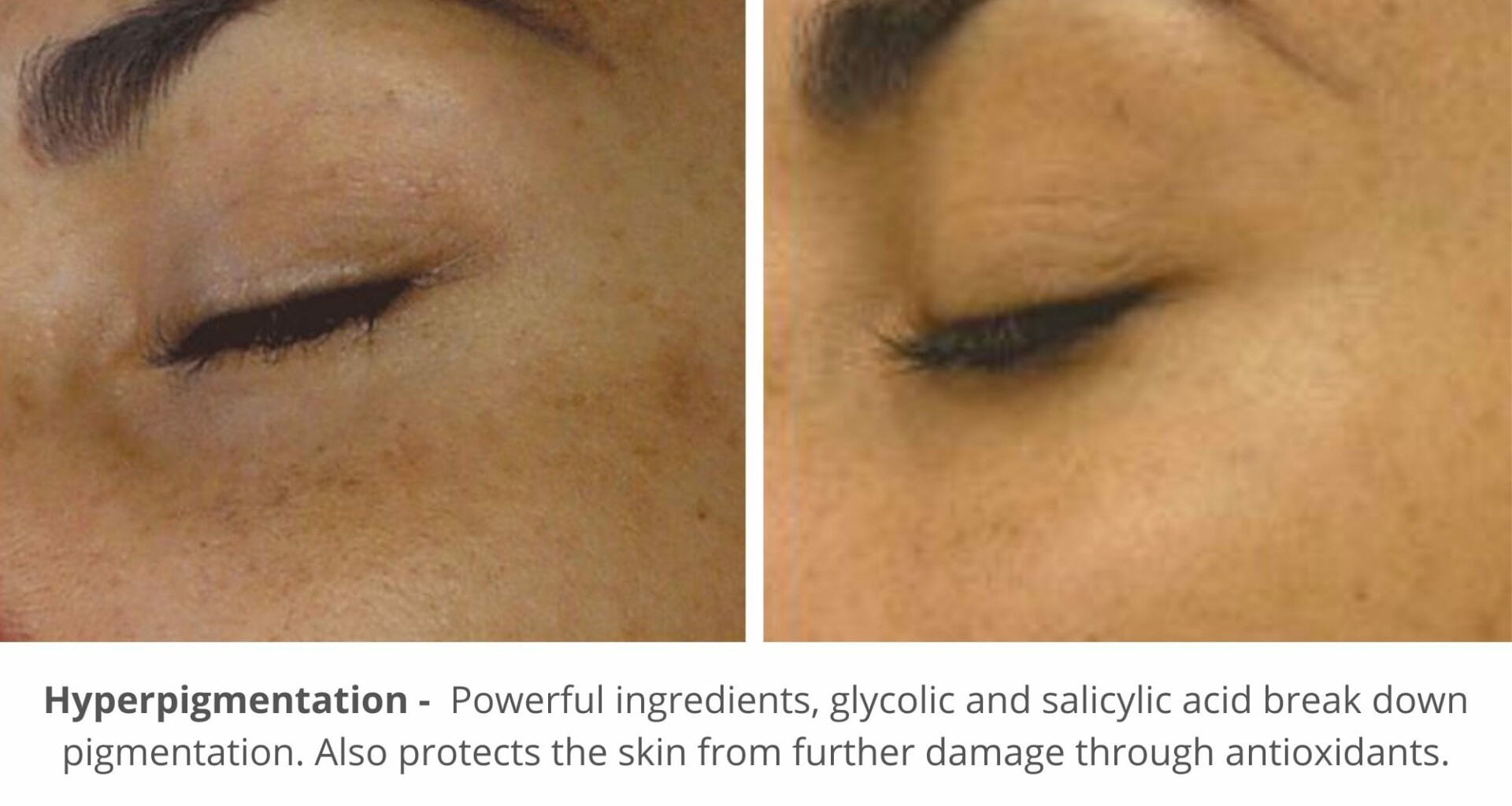 hydrafacial before and after photo for hyperpigmention
