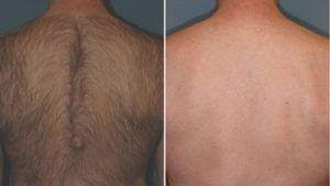 Mens Back Laser Hair Removal Everything You Need To Know  London Premier  Laser  Skin Clinic