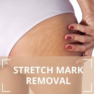 stretch mark removal on buttocks