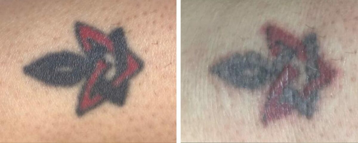 Tattoo Removal Surges 440% Over The Last Decade With No Signs Of Slowing Down