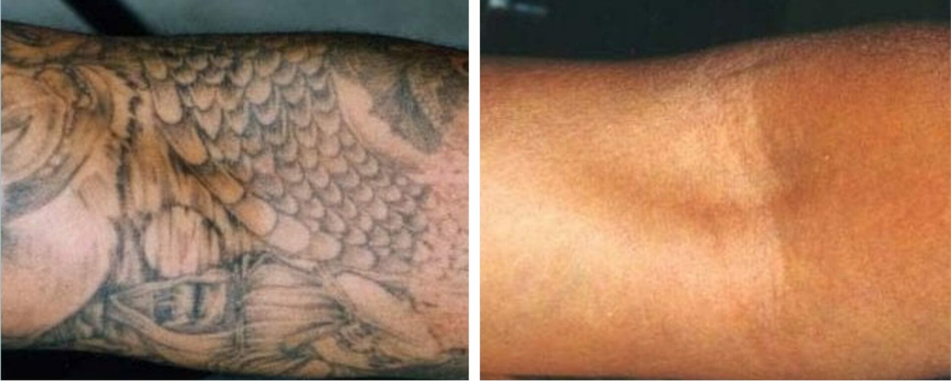 Is Tattoo Removal Safe? 5 Methods Reviewed - London Premier Laser & Skin  Clinic