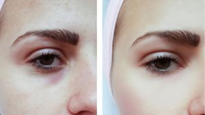 The Ultimate Guide To Pigmentation, Its Causes &#038; Treatments