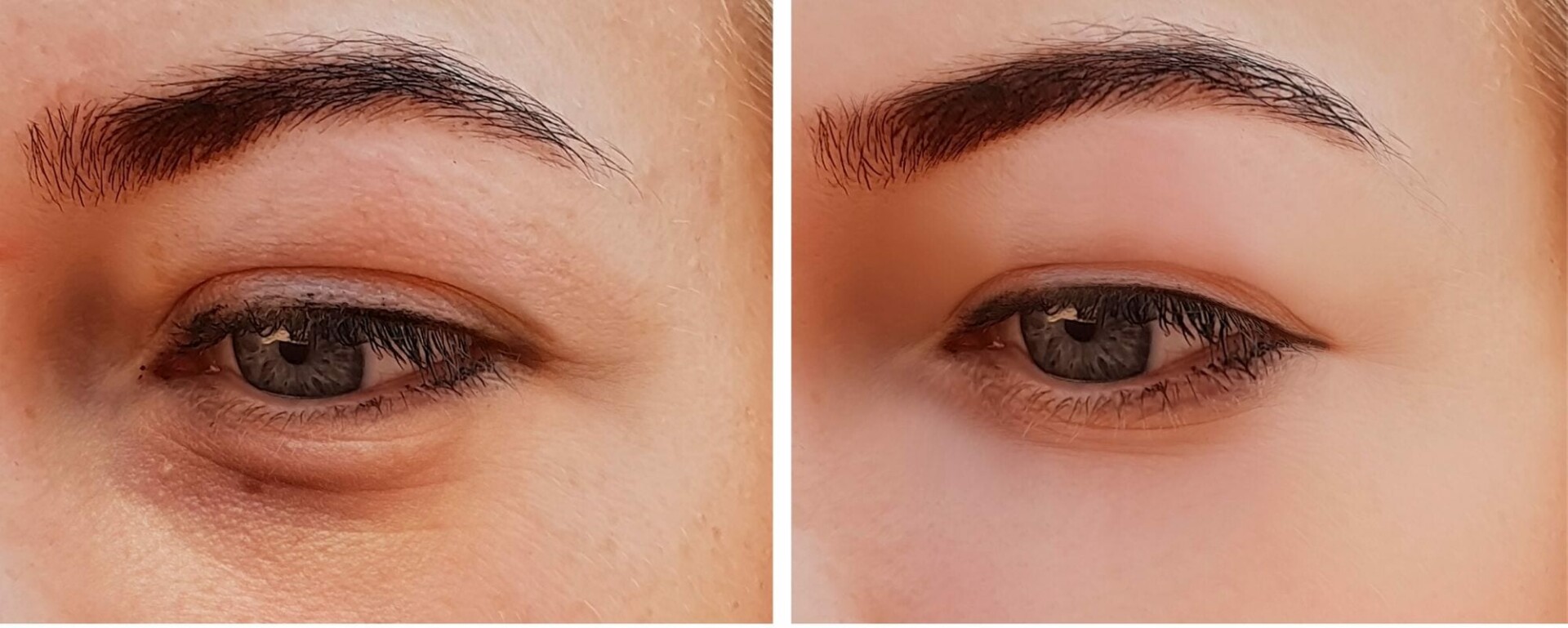 eye bags before and after