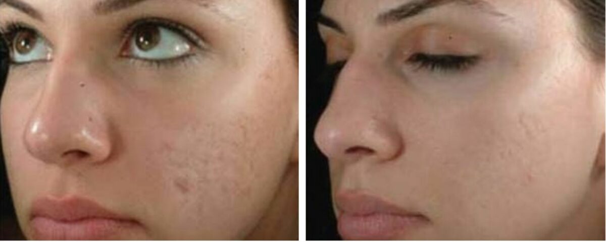 Treat Acne Scars and Stretch Marks With Sublative Rejuvenation