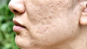 hydrafacial acne scars