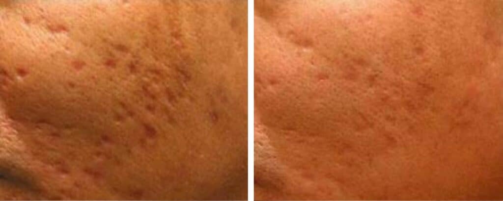 Acne Scar Removal before and after