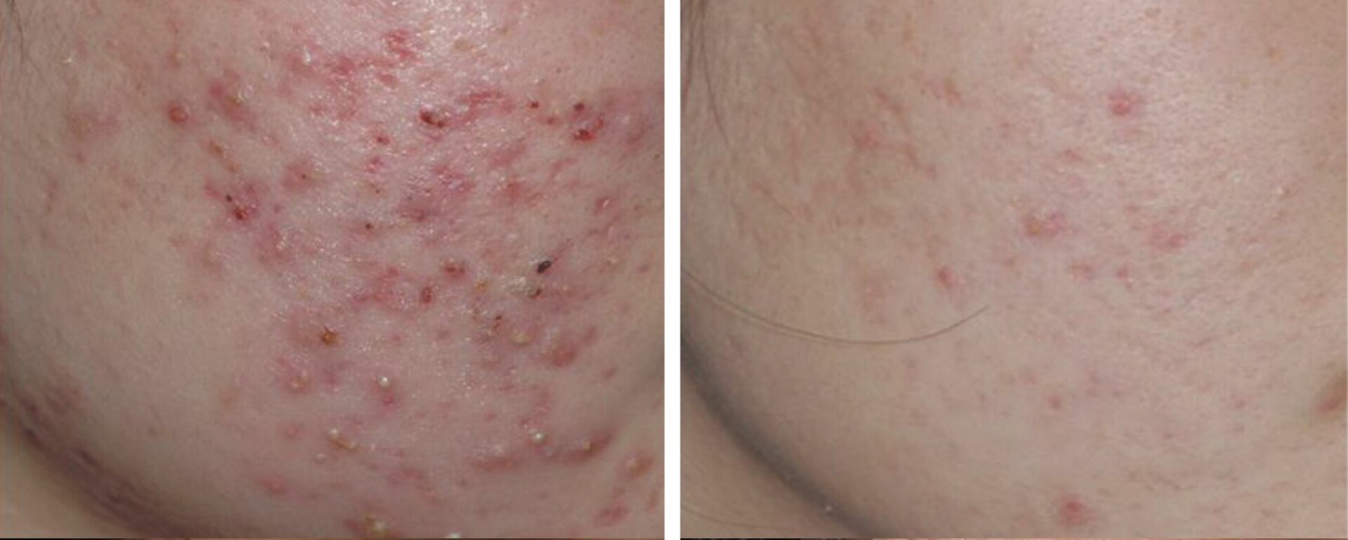 Getting Rid of Acne Scarring: What Are Your Options?