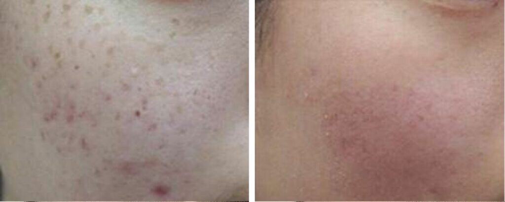 Acne Scar Removal before and after