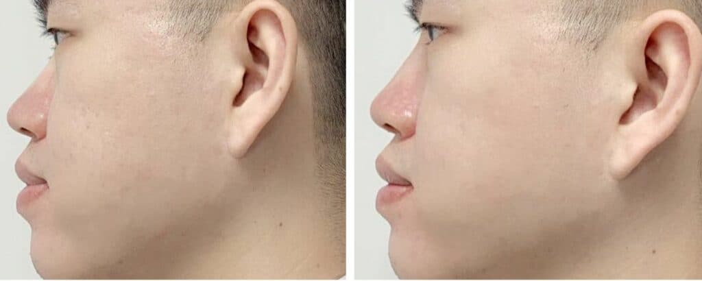 Acne Scar Removal before and after
