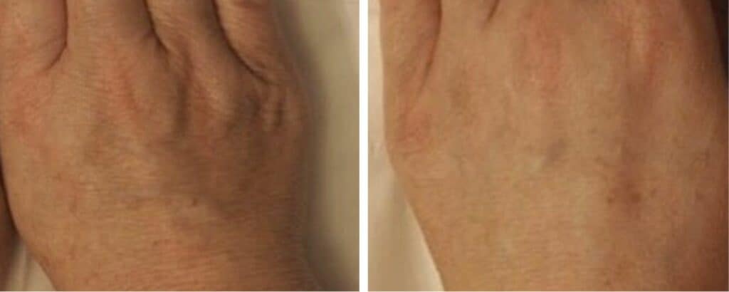 Age Spots on Hands before and after