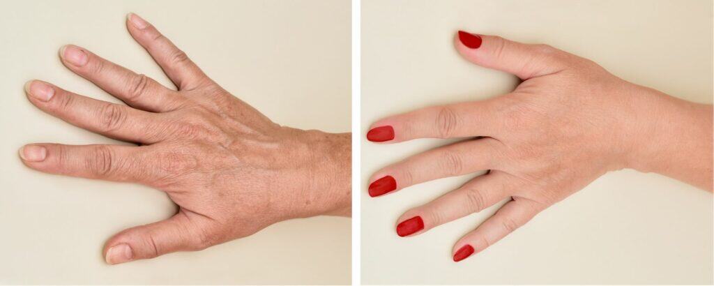 Age Spots on Hands before and after