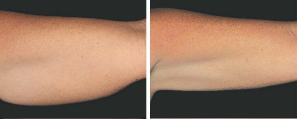 Fat Reduction Treatments before and after