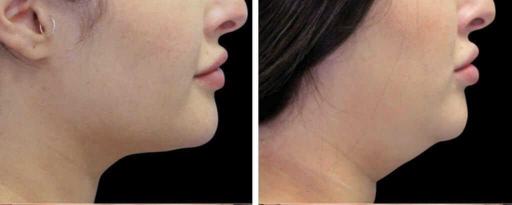 Fat Reduction Treatments before and after