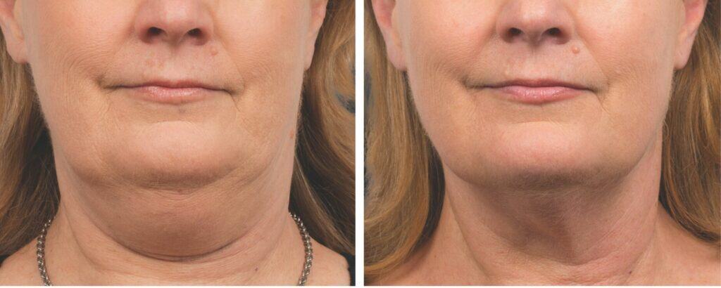 Fat Reduction Treatments before and after