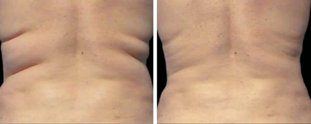 Fat Reduction Treatments before and after