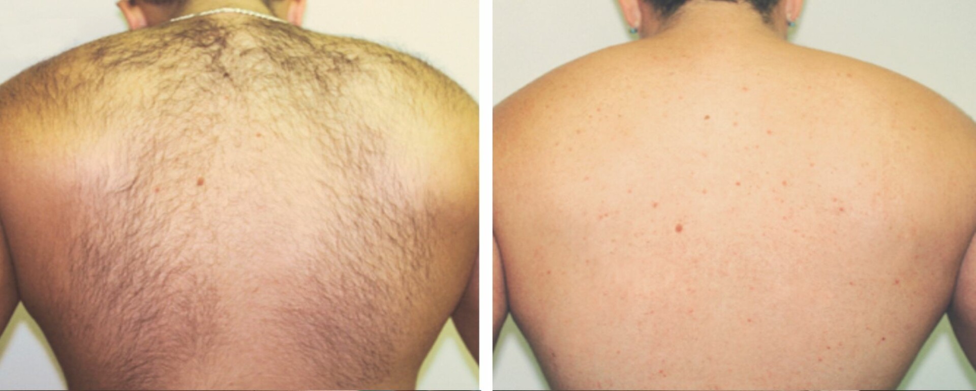 Everything Men Need To Know About Laser Hair Removal - London Premier Laser  & Skin Clinic