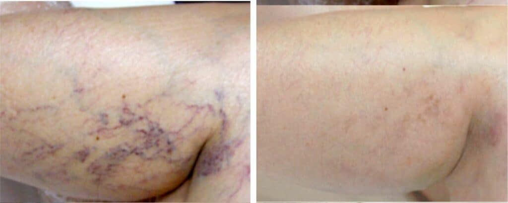 Leg Spider Veins & Varicose Veins Treatment before and after