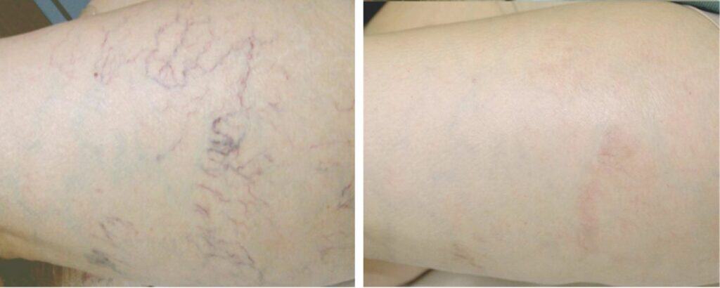 Leg Spider Veins & Varicose Veins Treatment before and after