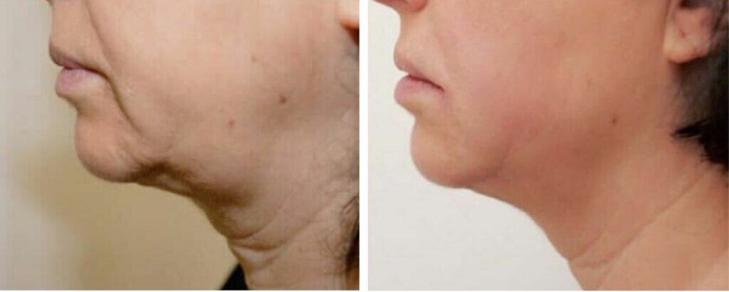 Sagging Facial Skin before and after