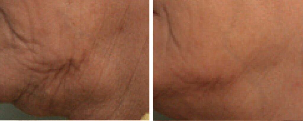 Sagging Facial Skin before and after