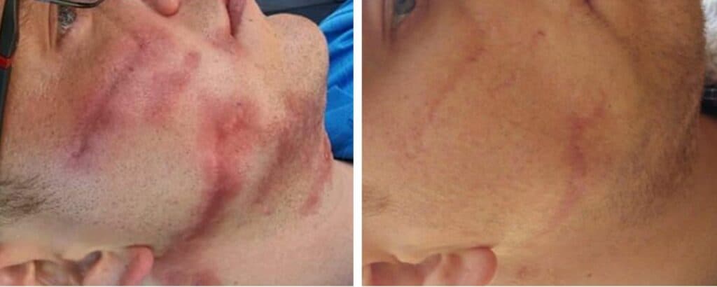 Scar Removal Treatments before and after