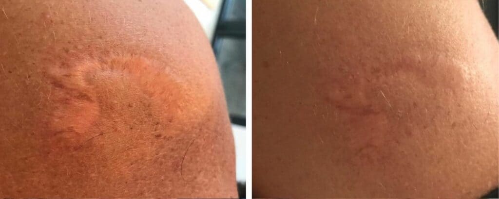 Scar Removal Treatments before and after