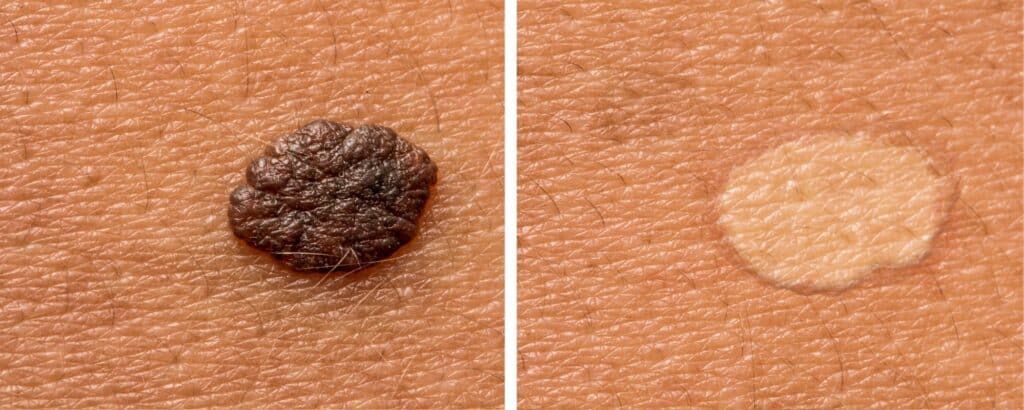 Skin Tag Removal before and after