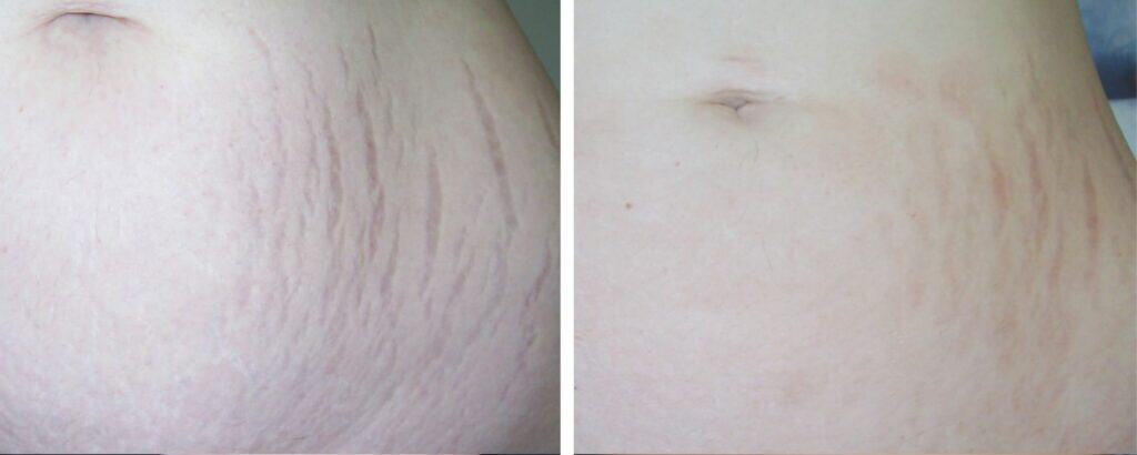 Stretch Mark Removal before and after