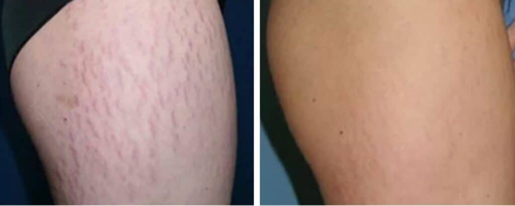 Stretch Mark Removal before and after