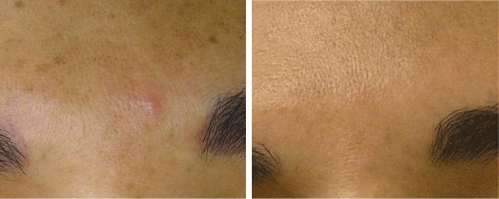 Sun Damage & Sun Spot Removal before and after