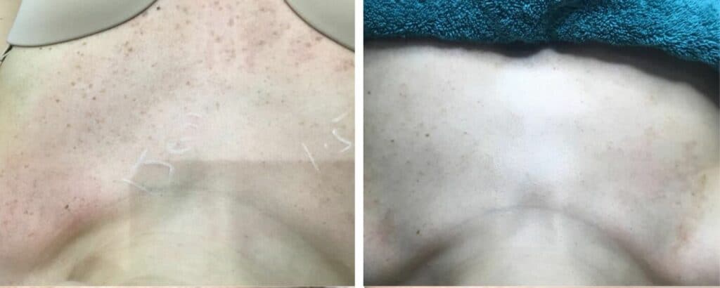 Sun Damage & Sun Spot Removal before and after