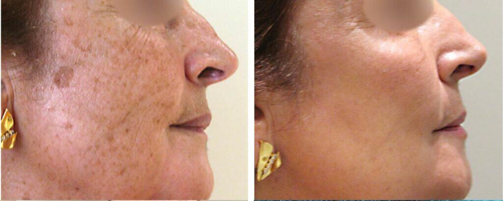Sun Damage & Sun Spot Removal before and after