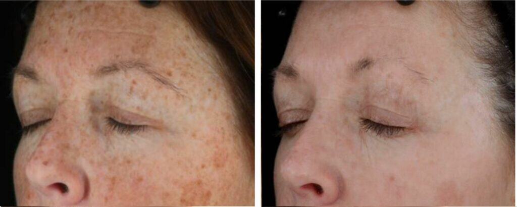 Sun Damage & Sun Spot Removal before and after