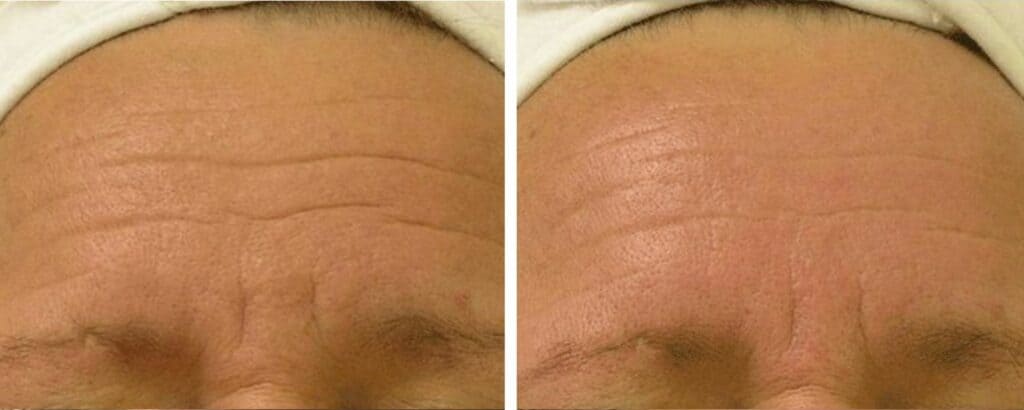 Lines and Wrinkles Treatments before and after