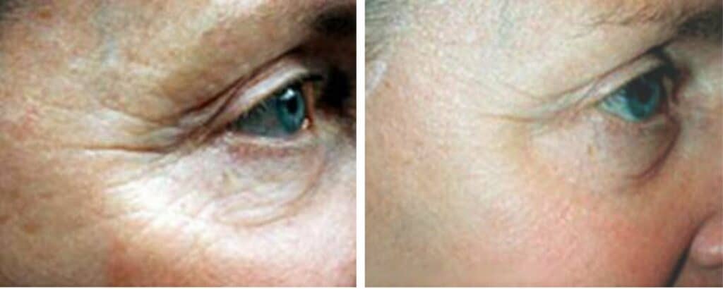 Lines and Wrinkles Treatments before and after