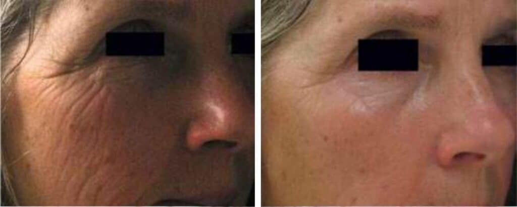Lines and Wrinkles Treatments before and after