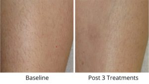before and after leg laser hair removal, post 3 treatments after 