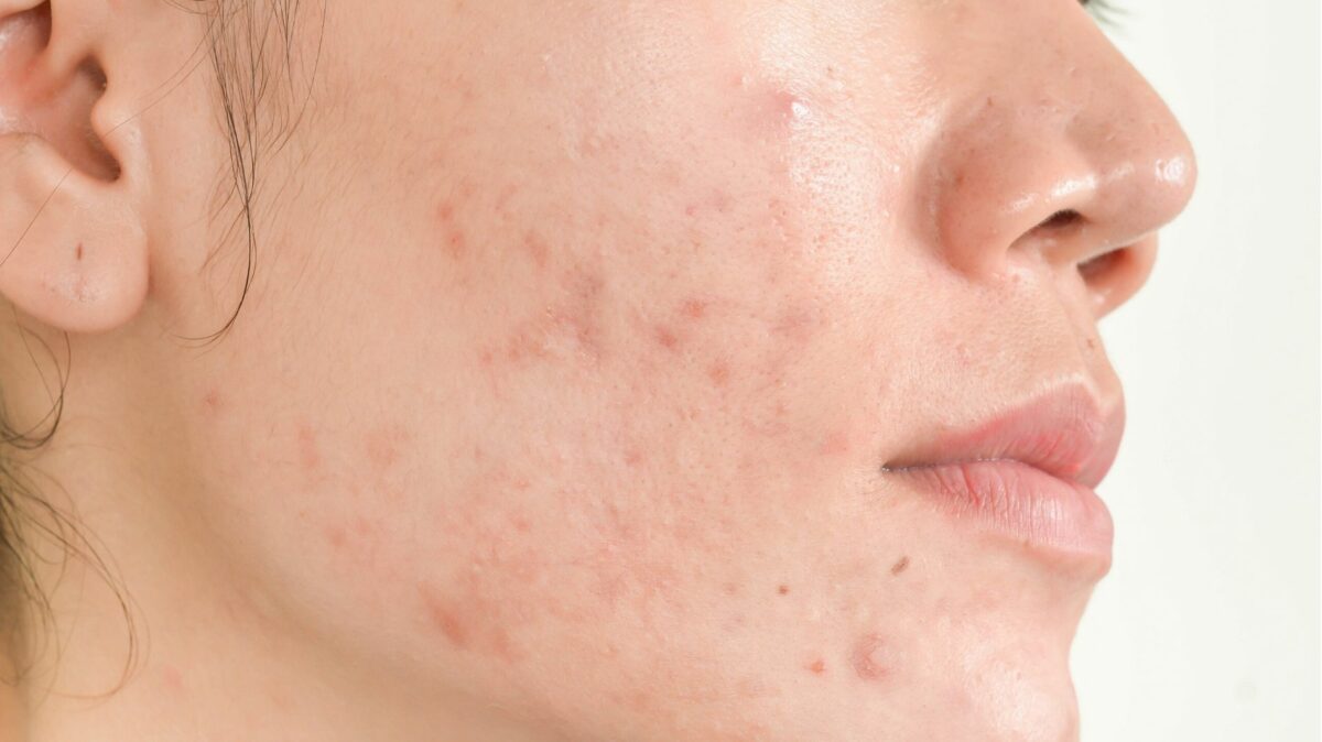 Which Acne Scar Treatment Is Best For You?