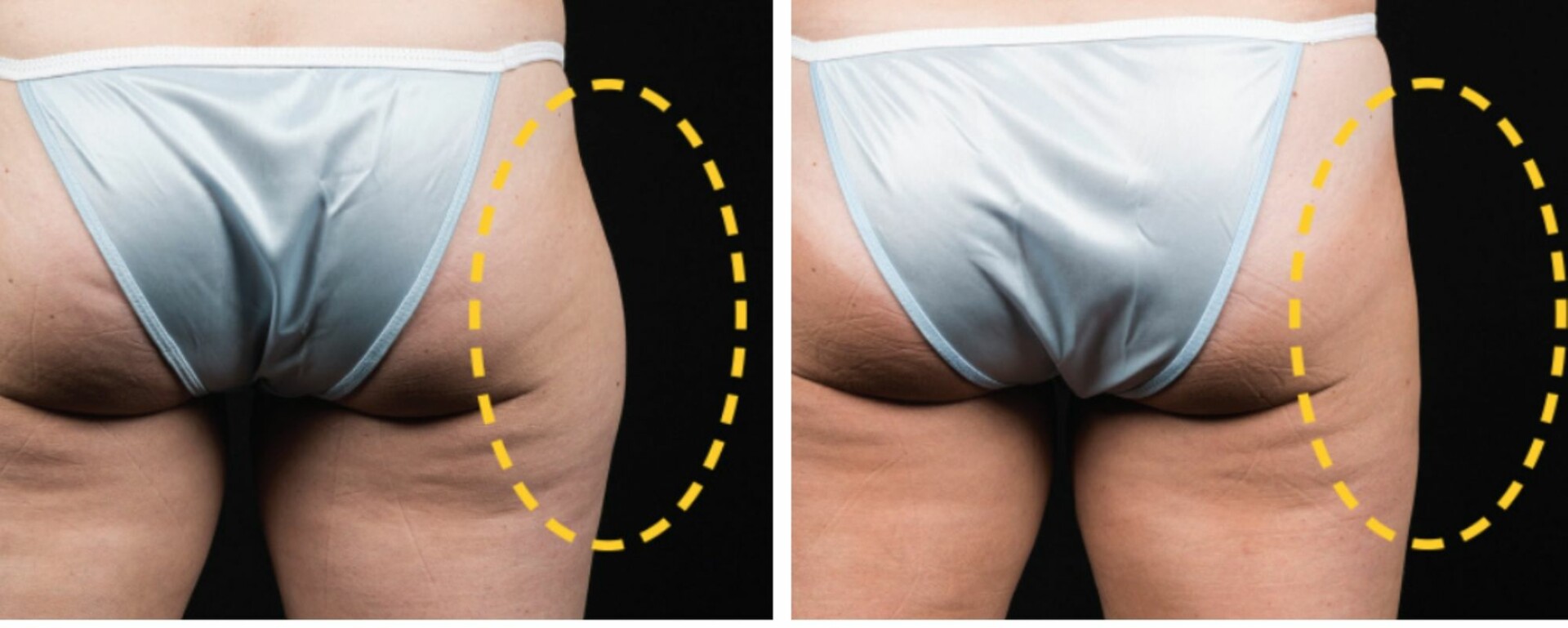 Cellulite And The Lymphatic System