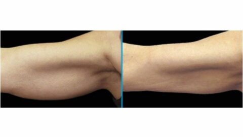 arm fat reduction before and after 